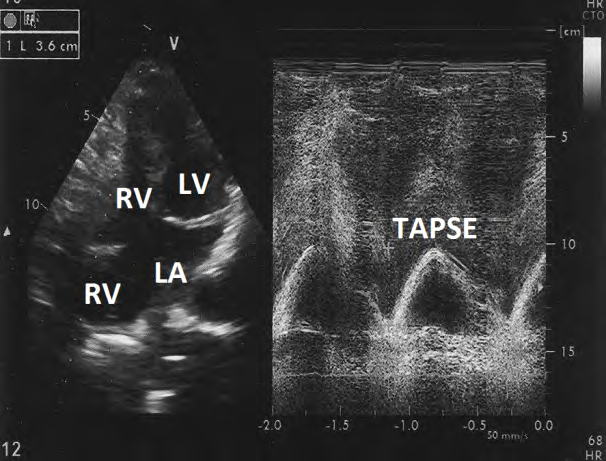 Figure 6: M- mode echocardiogram showing tricuspid annulus peak systolic excursion of 3.6 cm.