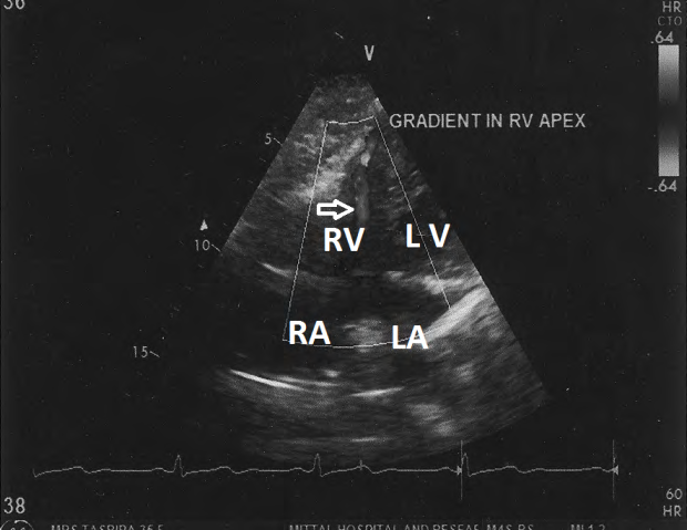 Figure 8: Colour Doppler evaluation showing turbulence in right ventricular apex (marked arrow).