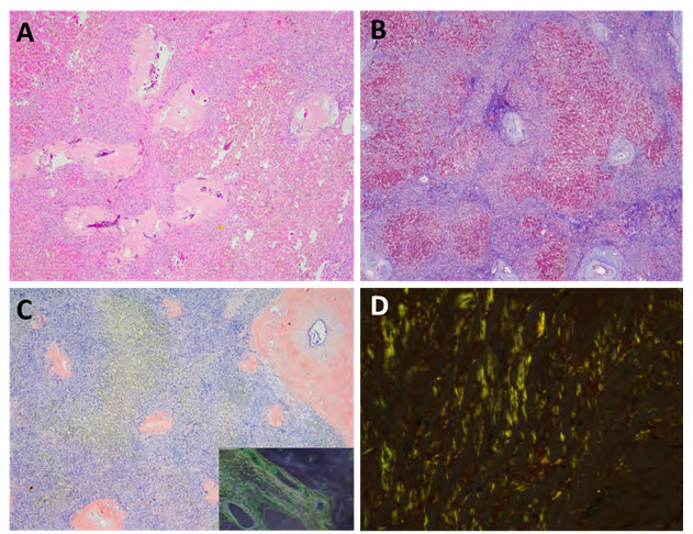 Figure 2: Explant liver histologic studies. A: Hematoxylin and Eosin stain shows deposition of amorphous material within the portal areas consistent with amyloid. B: Trichrome stain confirms the cirrhotic nature of the liver. C: Congo ted stain highlights the amyloid deposition, which shows apple-green birefringence under polarized light (inset). D: High power view of the amyloid birefringence under polarized light.