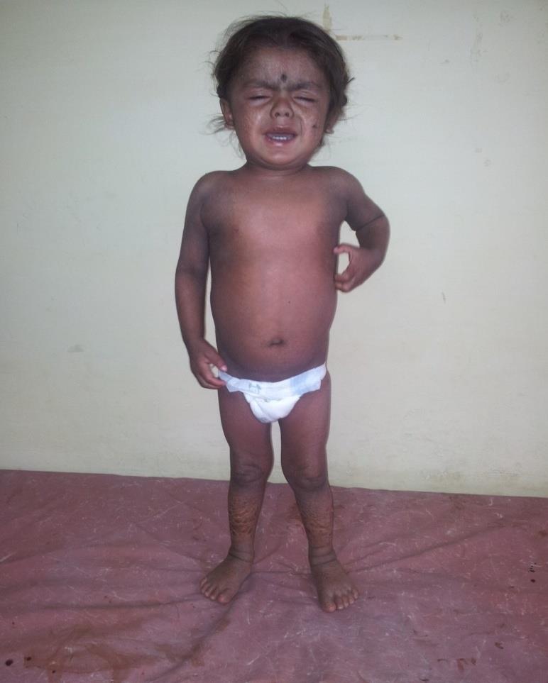 Figure 1: Child presenting with nonbullous icthyosiform erythroderma.