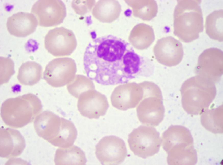 Figure 2: Peripheral blood smear showing Jordan’s anomaly.