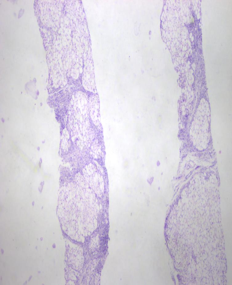 Figure 5: HPE of liver showing macrovescicular steatosis. (H & E 10X). With these typical featuresa diagnosis of CDS was considered. Isotretinoin 10 mg twice a week and emollients were prescribed along with a diet rich in medium chain triglycerides and deficient in long chain fatty acids. Follow up of the patient at 4 and 8 weeks showed progressively significant improvement in cutaneous lesions and normalization of liver function tests. Thus, a simple peripheral blood smear should be done to rule out CDS in any child presenting with ichthyosis and systemic involvement.
