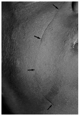 Figure 1: Courtesy of R.W. Byard [22].