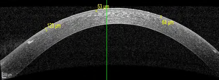 Figure 10: Non-crosslinked cornea 1 month post- operative: uniform flap thickness.