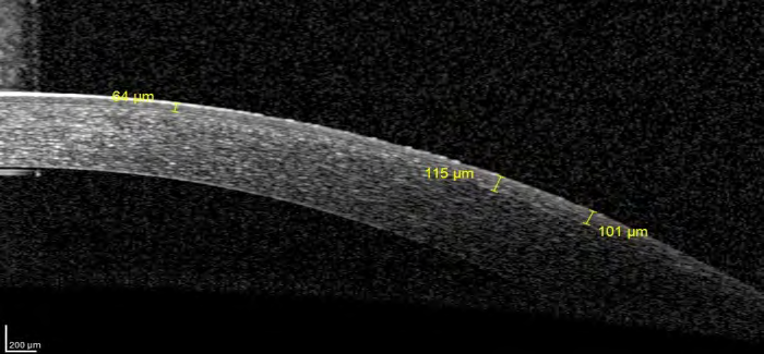 Figure 11: Cross-linked cornea 1 month post-operative: hyper reflectivity of the anterior stroma with traces of the demarcation line.