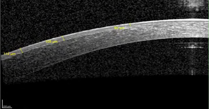 Figure 17: Crosslinked cornea 3 months post-operative: demarcation line at the peripheral cornea, fading at the Para central cornea, with flap decreased thickness.