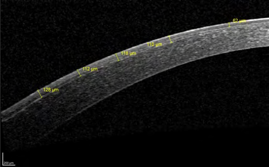 Figure 18: Crosslinked cornea 3 months post-operative: demarcation line at the level of 128µm, with flap shrinkage and decreased thickness (60µm).