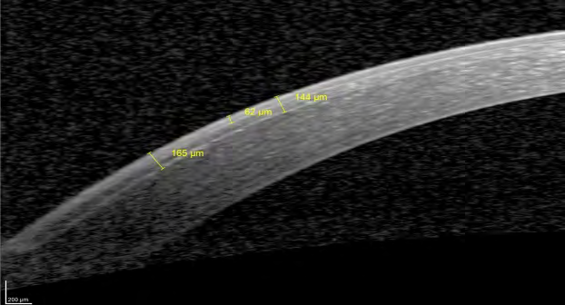 Figure 19: Crosslinked cornea 3 months post-operative: flap hinge is more visible in crosslinked corneas.