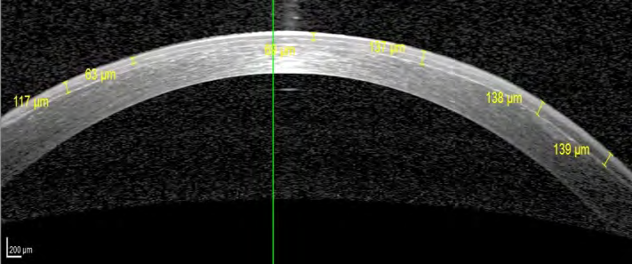 Figure 8: Cross-linked cornea 1 week post-operative: demarcation line at variable depths in the corneal stroma, fading in the Para central and central cornea.