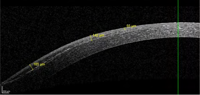 Figure 9: Cross-linked cornea 1 week post-operative: hyper reflectivity of flap hinge, demarcation line fading in para central cornea, a hypo reflective zone between the demarcation line and the anterior crosslinked stroma and flap.