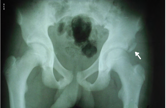 Figure 1: Avulsion of the left antero-inferior tibial spine (arrow).