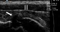 Figure 2: Ecosome, Avulsion of the anterior inferior iliac spine (arrow), Thickening of the rectus femoris muscle (double arrow).