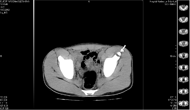 Figure 3: Pelvic CT, Avulsion of the left anterior inferior iliac spine (arrow).