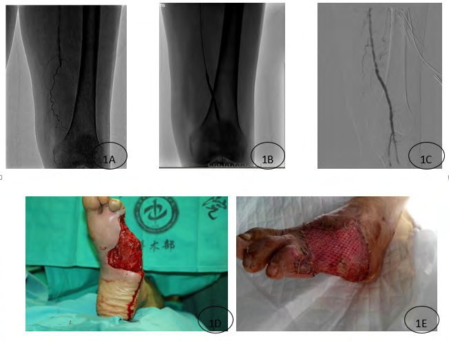 Figure 1: Percutaneous transluminal angioplasty. Treatment 1 Left foot ulceration. 1A. PTA intraoperative arterial angiography showed left lower extremity femoral artery occlusion; 1B. Angiography showed occlusion of the line segment balloon dilatation; 1C. After re-angiography showed superficial femoral artery patency; 1D. Debridement 12d, Full, light touch bleeding, red color; 1E. Ⅱ period after skin grafting 7 d, skin survival is good.