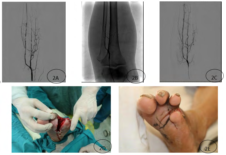 Figure 2: Patients with percutaneous transluminal angioplasty in patients with left foot fourth toe ulceration. 2B. Angiography showed balloon dilatation of the stenosis segment; 2C. Anterior tibial artery patency again; 2D. 8 days after debridement, the granulation was bright red, and the anterior segment of the anterior tibial artery was smooth. , Full, light bleeding, red color; 2E. Ⅱ residual suture after 14 days, suture healing.