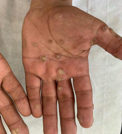 Figure 1: Keratotic palmar papules.
