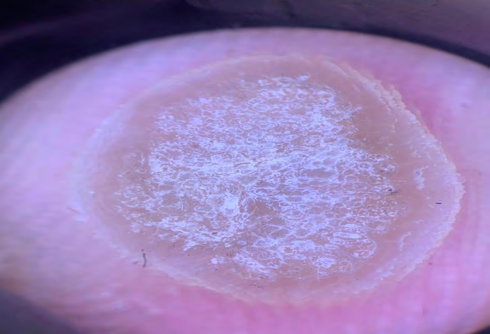 Figure 4: Dermoscopic appearance: “Frog Spawn like” pattern.