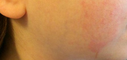Figure 1: Fine scaling pink-red scales were noted on the cheek of the patient.