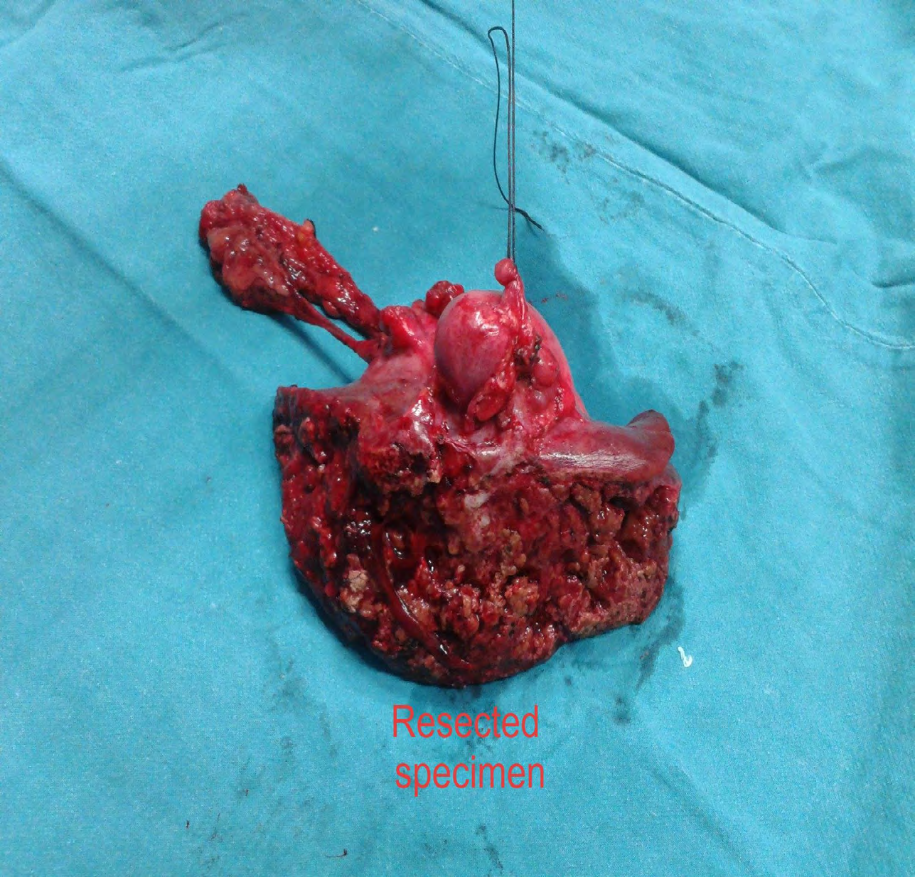 Figure 1: Resected specimen.