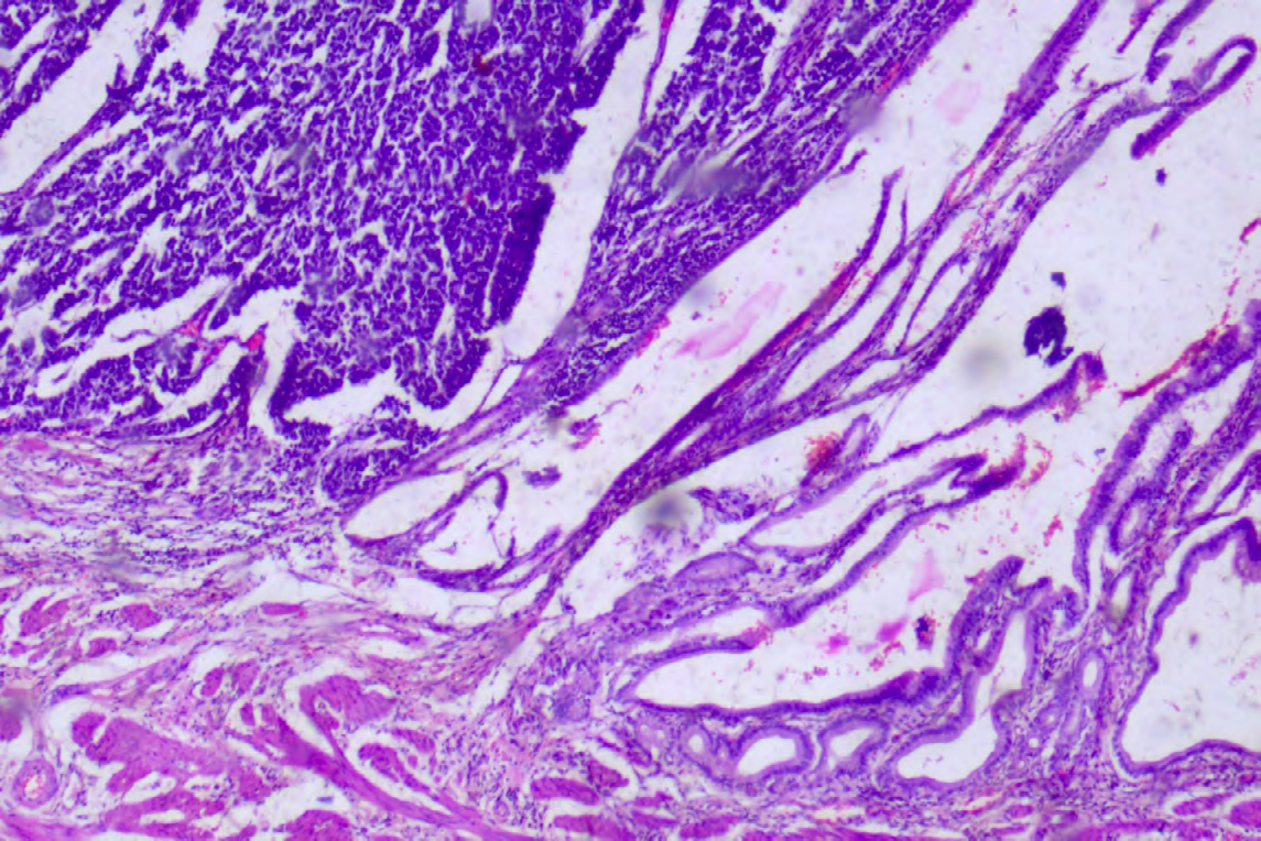 Figure 3: Microscopy image, H&E, 20X, showing infiltrating malignant glands.