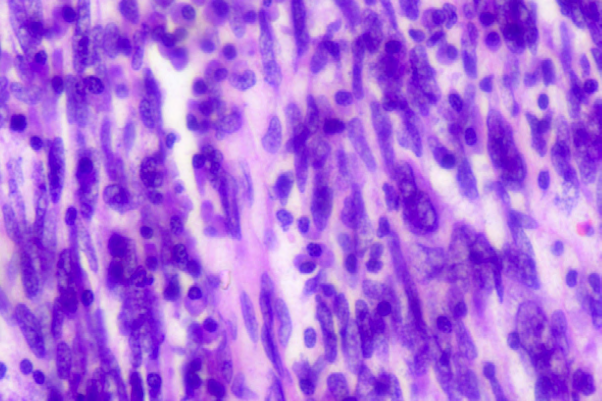 Figure 4: 40X, H & E, pleomorphic malignant spindle cell.
