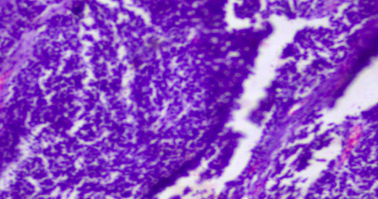 Figure 5: 40X, H&E, neuroendocrine differentiation.