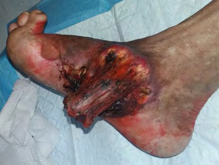 Figure 1: Epidermoid carcinoma of the medial side of the ankle and the forefoot on the right side.