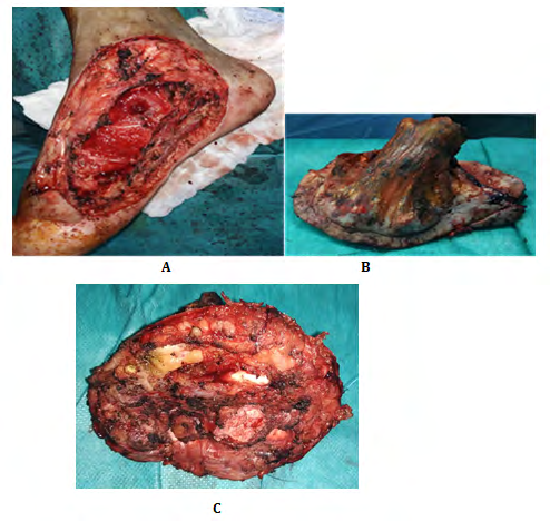 Figure 2: A. Loss of substance after carcinological excision. B and C. Tumor piece removing the soft parts of the inner side of the ankle, the 1st metatarsal and the inner part of the medial cuneiform and navicular bone.