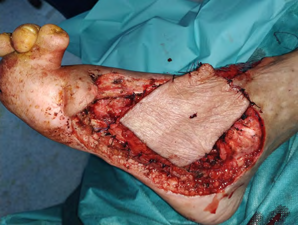 Figure 3: Coverage of substance loss by the external supramalleolar flap.