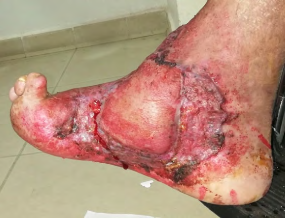 Figure 5: Loss of substance on the inside of the left ankle and heel after trimming, exposing the tibio-astragonal joint, posterior tibial pedicle and medial plantar pedicle.