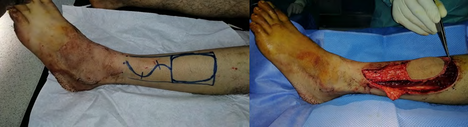 Figure 7: A and B: partial necrosis of the distal half of the flap managed by directed wound healing and thin skin grafting.