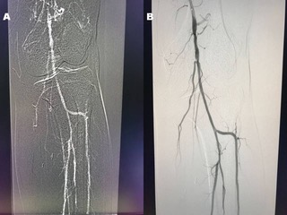 Figure 1: (A) Representation of the CO2 DSA of popliteal and infrapopliteal arteries. (B) IC DSA representation of the same image of popliteal and infrapopliteal regions.