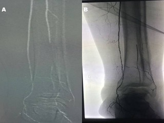 Figure 2: (A) CO2 DSA patent posterior tibial artery, occluded middle 1/3 of the peroneal artery, non-visualized anterior tibial artery. (B) IC DSA presentation of the patient’s posterior tibial artery occluded middle 1/3 of the peroneal artery, and non-visualized anterior tibial artery.