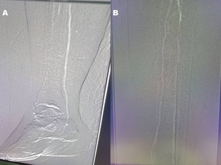Figure 3: (A) CO2 DSA showing the posterior tibial artery as the only runoff. (B) CO2 DSA showing properly visualized posterior tibial and peroneal artery.