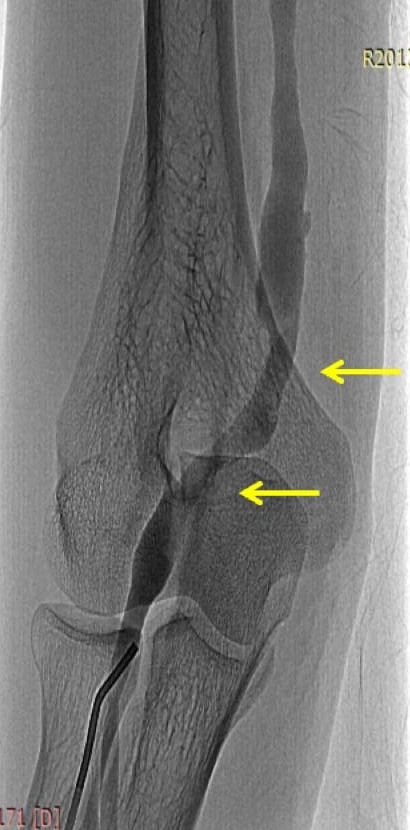 Figure 2: Post balloon dilatation angioplasty angiogram.
