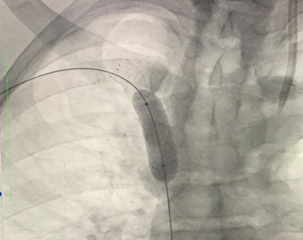 Figure 5: Stent deployment in the right brachiocephalic vein.