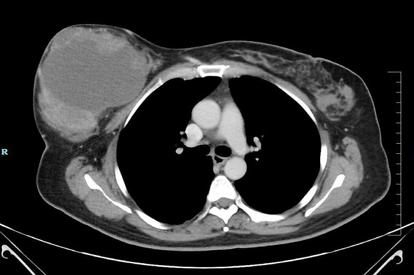 Figure 2: CT thorax of the patient showing the tumour and the opposite side for comparison.