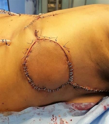 Figure 3: Immediate post-operative period, showing the latissimus dorsi flap reconstruction.