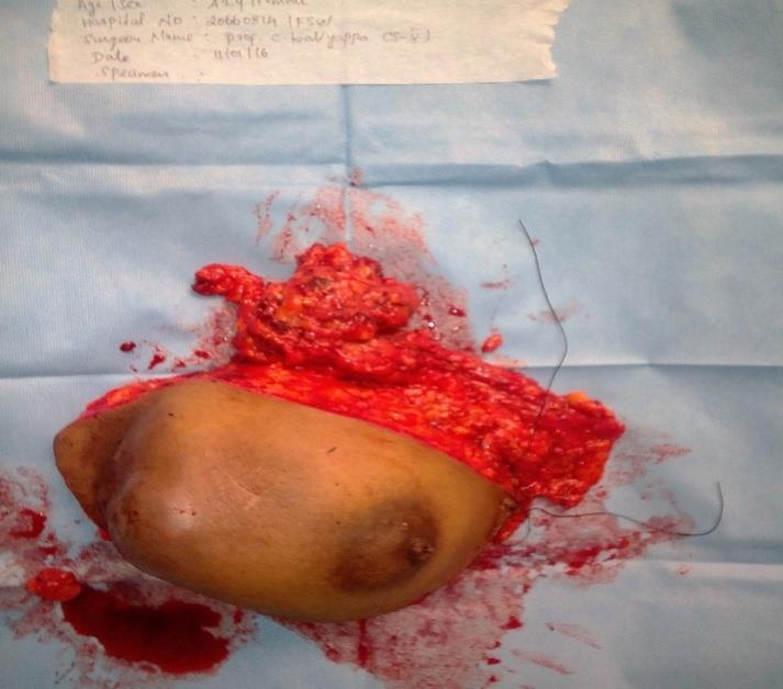 Figure 4: Gross image of the excised specimen.