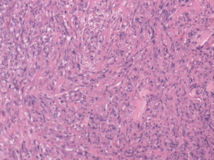 Figure 5: Histopathological slide showing the tumour at 10x magnification.