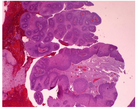 Figure 1: Fragments of wall cervical Carcinoma squamous cell grows to form papillae around an axis fibroconective and vascular.