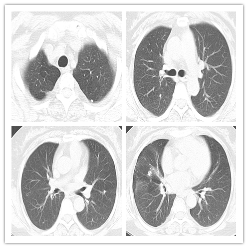 Figure 1: Computed tomography of the chest.