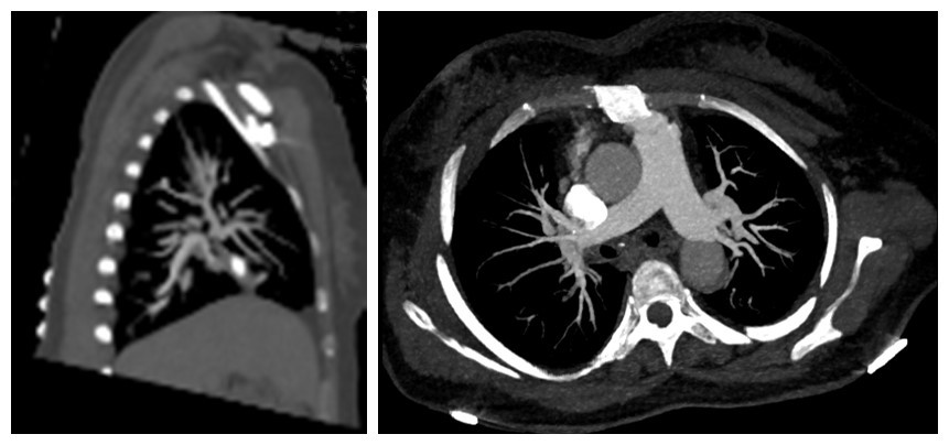 Figure 3: Computed tomographic pulmonary angiography.