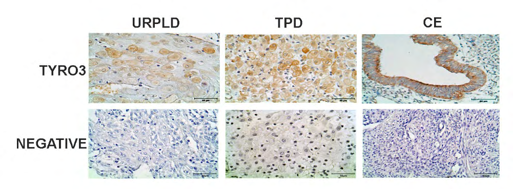 Figure 3: Immunohistochemistry staining of the Tyro3 receptor kinase on URPLD, TPD, and CE. Localization on DSCs of the Tyro3 receptor kinase protein shows with the black arrow.