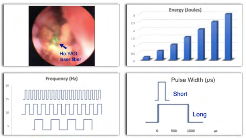 Figure 3: Laser system settings that could be adjusted during lithotripsy. Energy(J), Frequency (Hz), Pulse width (µs).