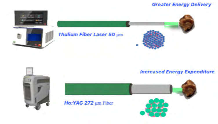 Figure 4: Larger laser fibers (Ho:YAG 272 μm) are associated with increased energy expenditure to achieve stone fragmentation without improving the fragmentation efficiency, small fibers are associated with greater energy delivery (TLF 50μm).