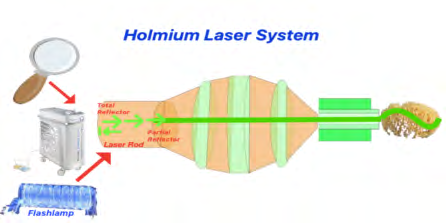 Figure 5: TFL generates the energy through electronically- modulated chemically doped small diode laser. fibers and is then transferred to a 10-20 µm Thulium-doped laser fiber which finally delivers this energy to the small laser fibers of 50-150 µm. TFL offers the most comprehensive range of laser parameters in the market, better absorption coefficient and water optical penetration depth.