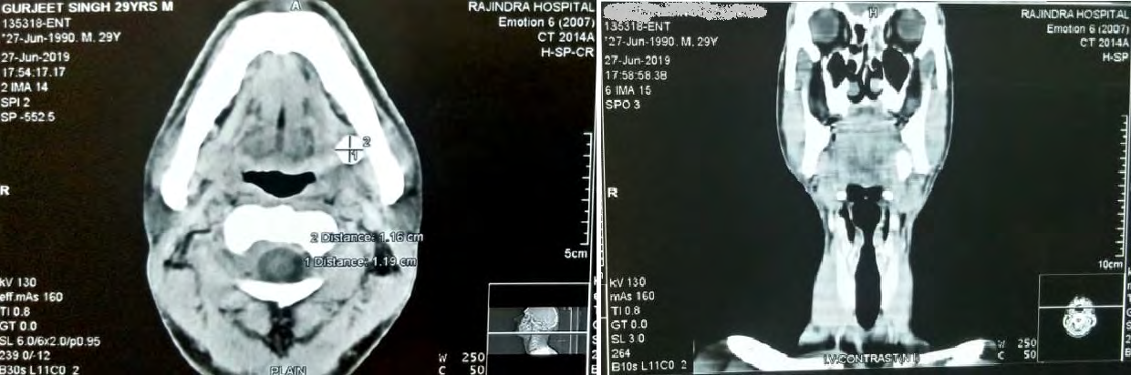 Figure 1: CT scan axial and coronal cuts showing hyper dense shadow in the left submandibular region.