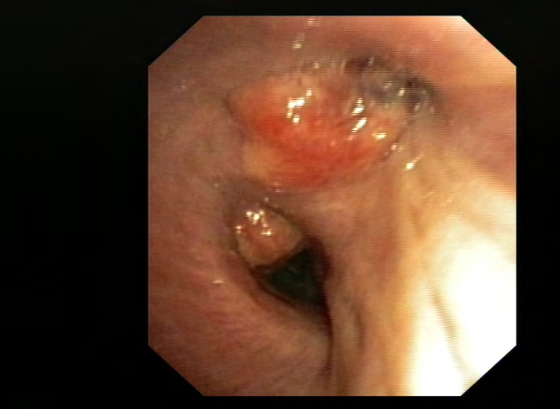 Figure 1: Endobronchial view: mucosal thickening located at the carina between the right superior bronchus and the intermediate bronchus. Mixed cellularity Hodgkin’s lymphoma, Personal case.