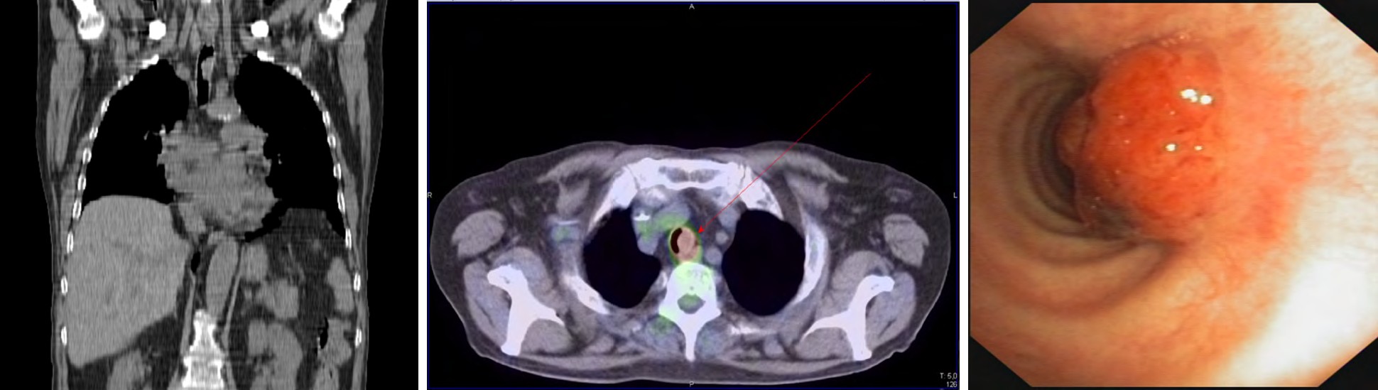 Figure 2: A: chest CT, coronal view, EL visible in the proximal trachea. B: PET-CT, axial view, showing FDG-avid tissue in the proximal trachea. C: Endotracheal view: vascularized polypoid lesion in the proximal trachea. Burkitt’s lymphoma. Personal case.